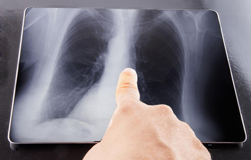 Digital X-Rays Vs Traditional X-Rays: The Differences